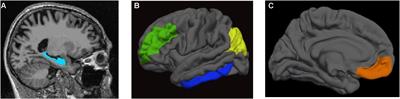 Reduced Regional Cerebral Blood Flow Relates to Poorer Cognition in Older Adults With Type 2 Diabetes